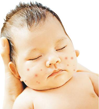讀者MailBox：皮膚出疹 新生兒常見