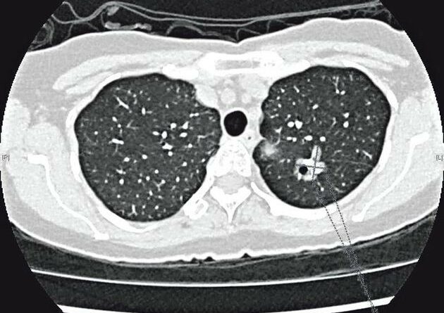 醫學滿東華：低輻射掃描 篩檢早期肺癌