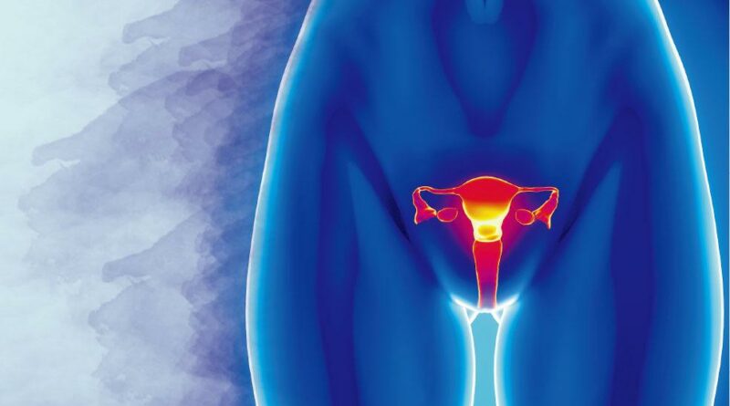 晚期卵巢癌80%復發 腹腔化療延長8至16月壽命