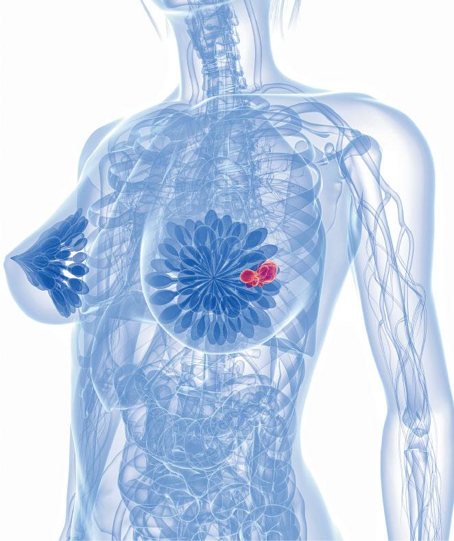 【乳癌電療】善用呼吸法護心 減輻射引致心病風險