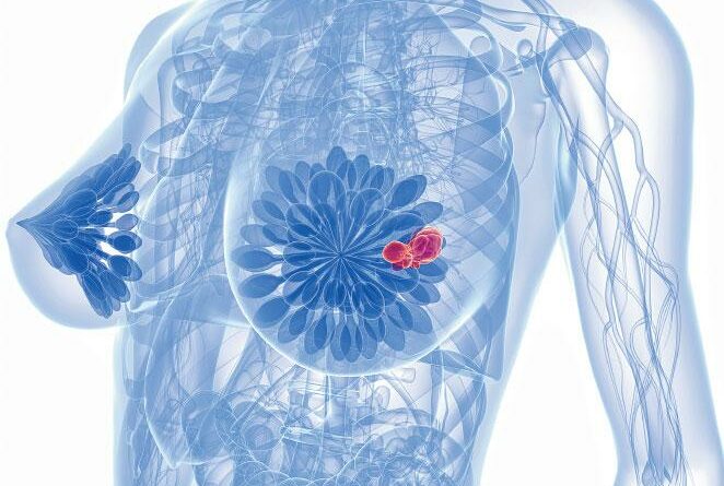 【乳癌電療】善用呼吸法護心 減輻射引致心病風險