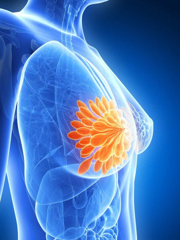 【女性疾病】 乳癌術前化療助縮瘤 新標靶藥提升治癒率