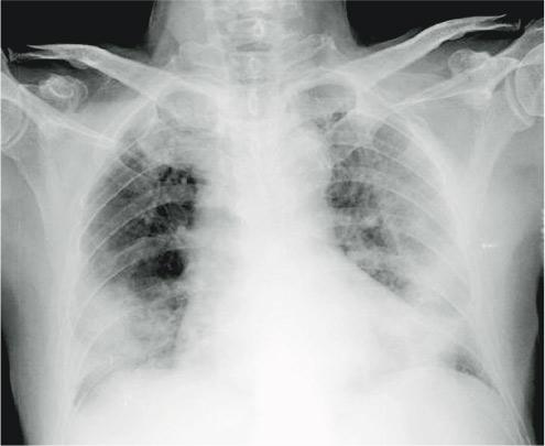 肺部有陰影｜肺腑之言：如何診斷「肺花」？