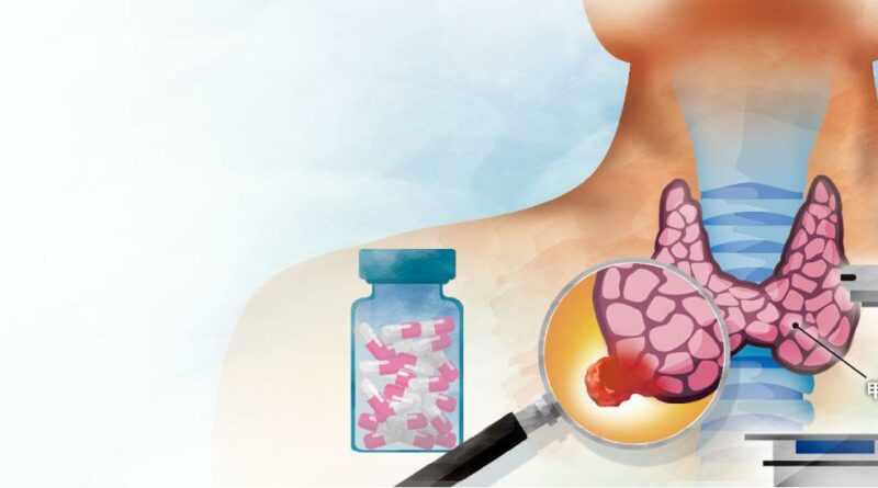 十大癌症丨甲狀腺髓質癌 用碘無效 尋精準治療