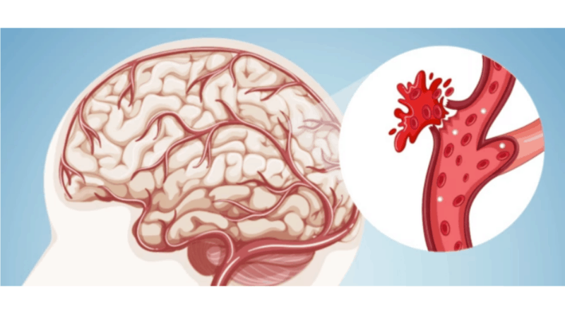 動脈瘤丨醫學滿東華：腦血管造影 快速尋病因撿命