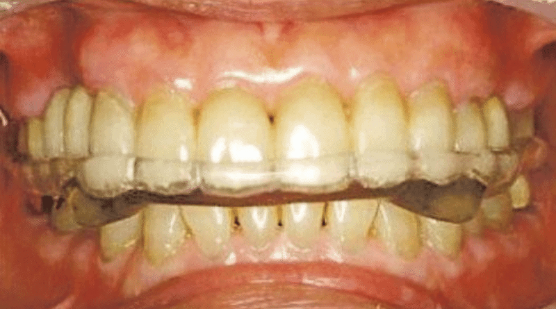 【磨牙】長期磨蝕牙齒礙進食 致牙骱痛、頭痛 磨走琺瑯質增敏感牙齒機會 注意睡眠窒息、壓力響警號