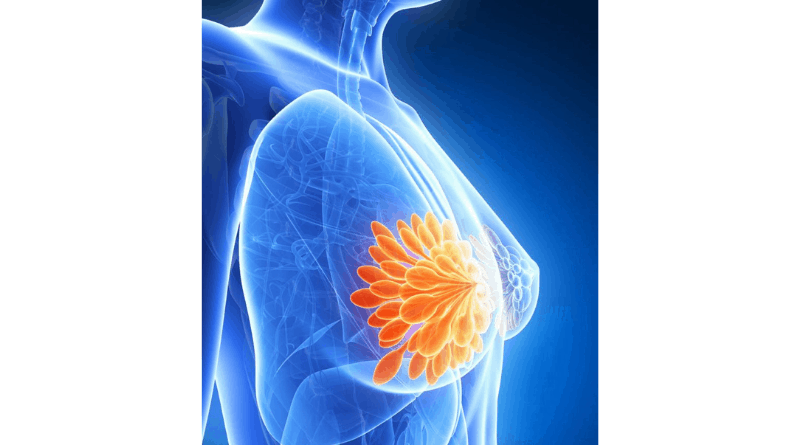 【乳癌】早期徵狀不易察覺 時刻關注乳房健康 留意6個不尋常變化（衛生處方）