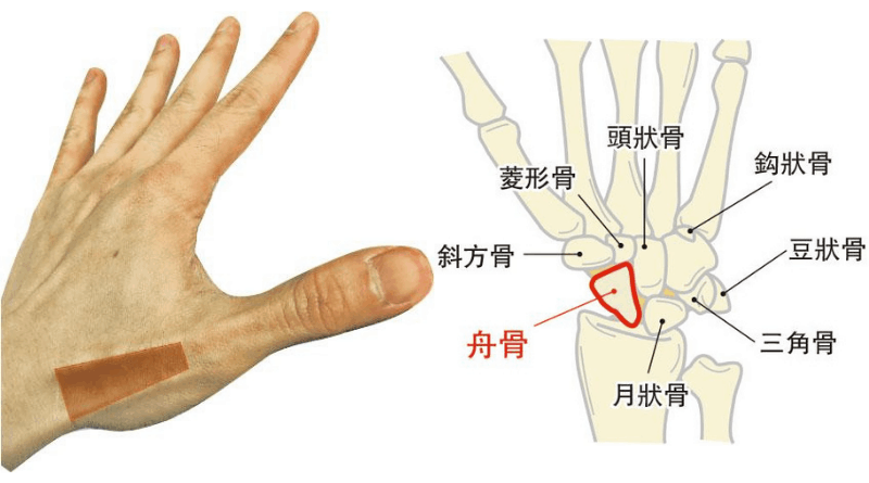【骨折】手腕「舟骨」骨折病徵不明顯 手腕僵硬難活動