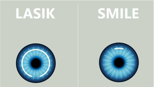LASIK和SMILE適合不同近視和散光度數的人士，後者的傷口較細，但術後完全恢愎視力的時間較長。（網上圖片）