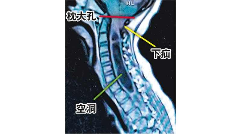 脊柱側彎常見徵狀肩膊不平衡 嚴重可影響心臟和肺 或暗藏小腦病變（醫路同行）
