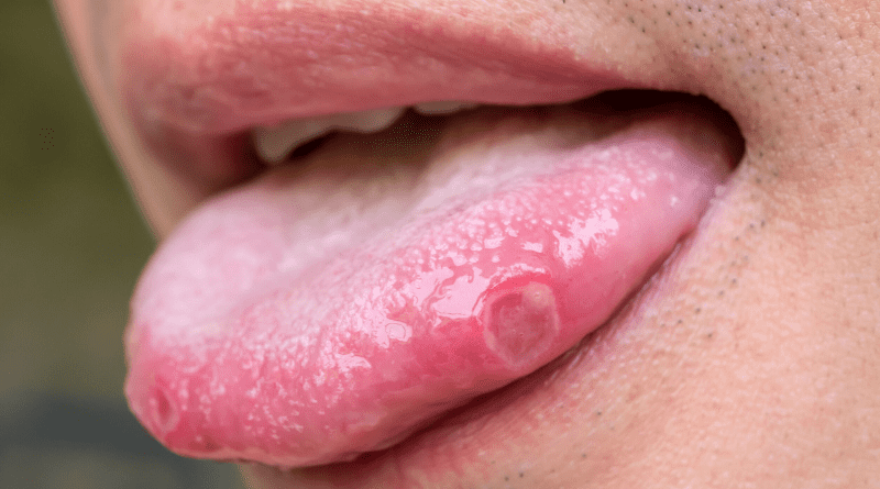 【口腔癌先兆】痱滋、口腔內白斑逾兩星期未癒？留意5S風險因素 及早發現提升存活率