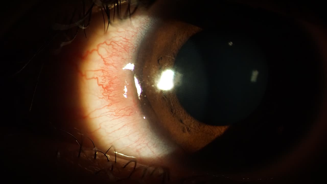 部分眼敏感患者可以在短短數分鐘或數小時內出現眼紅徵狀。