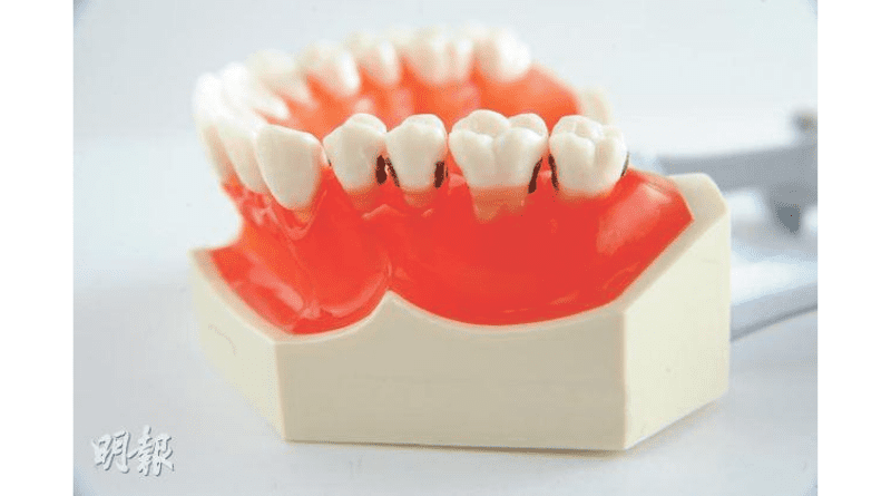 【蛀牙】自助補牙勿亂試 易積聚牙菌膜致牙齦發炎 了解6個補牙程序及常用物料