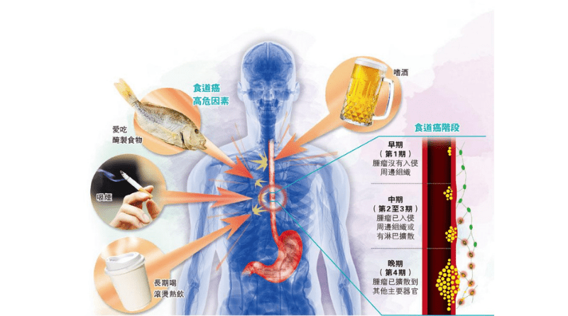 【食道癌】死亡率高 常見病徵吞嚥困難 注意5大高危因素：吸煙、嗜酒、長期胃酸倒流