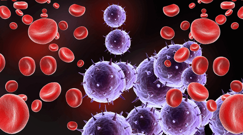 【血癌病徵】認識血癌三大類：白血病、骨髓瘤、淋巴瘤 影響造血、免疫能力