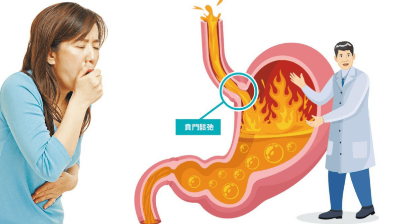 【胃酸倒流】6個典型症狀：胸口灼熱、反酸、吞嚥不順、喉嚨有異物感、咳嗽、口苦 中醫：飲食不節壓力大肝胃不和