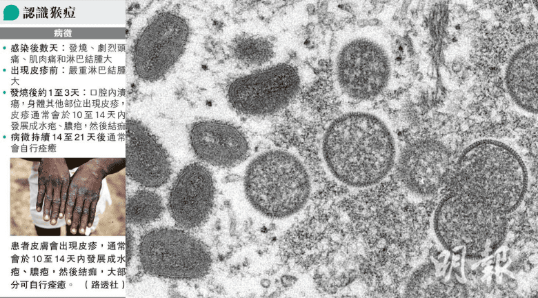 【猴痘】潛伏期長 了解猴痘3種傳播途徑、病發前後病徵及兩大高危因素