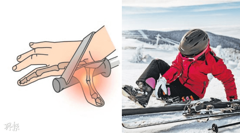 滑雪有風險 跌倒可致拇指骨折 膝關節最易傷 新手老手要注意